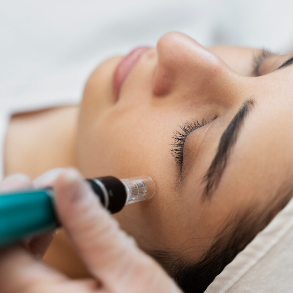 Pensat microneedling