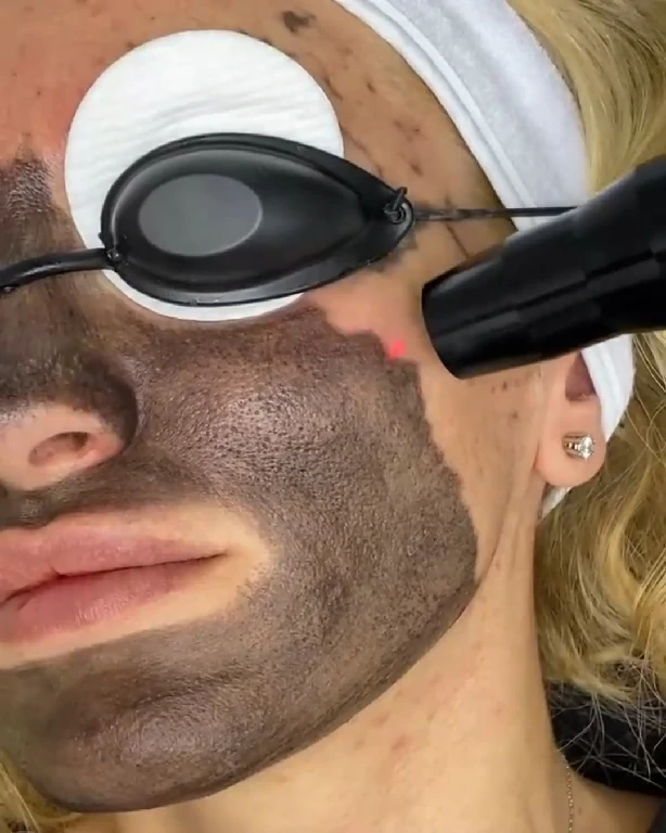 Laser Nd:YAG profesional, Skinderella Hollywood Peel