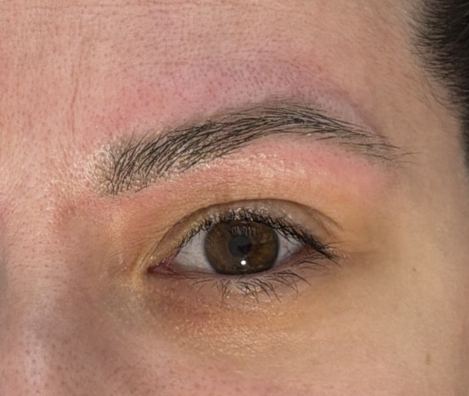 După, Îndepărtare tatuaj cu laser