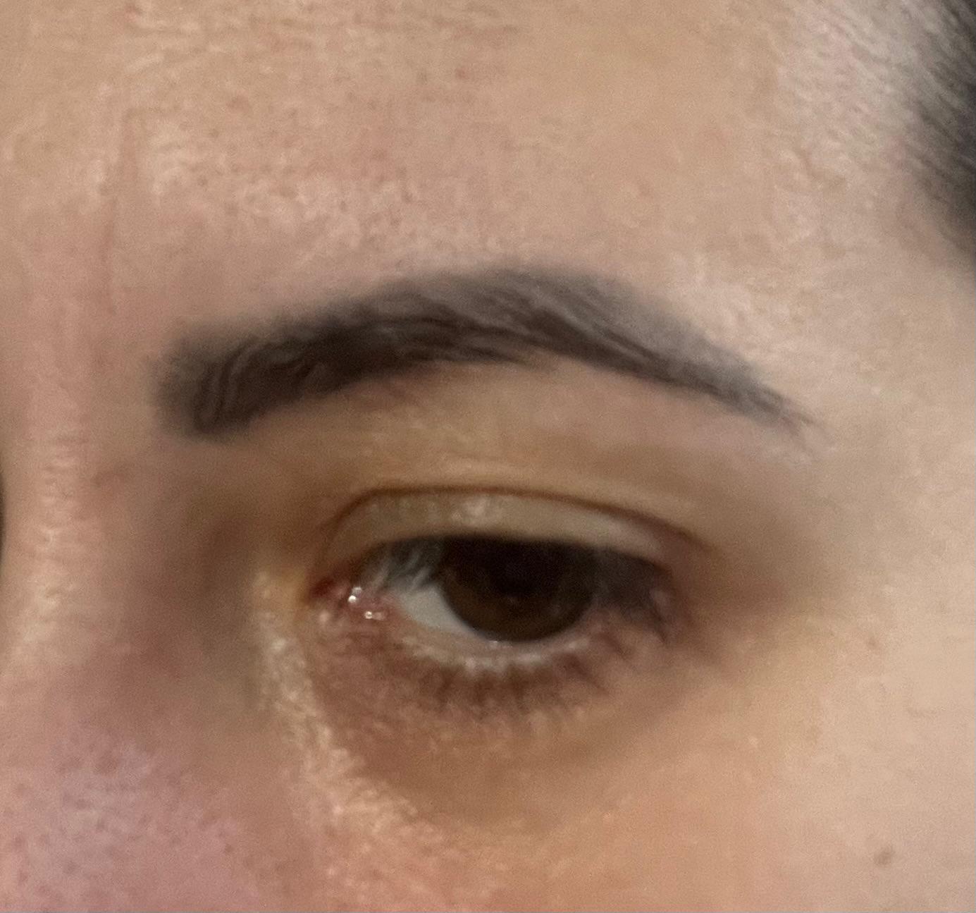 Înainte, Îndepărtare tatuaj cu laser